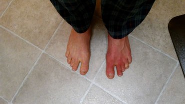 my feet: one normal, one in an erythromelalgia flare